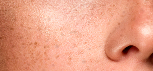 Pecas: cómo hacerlas